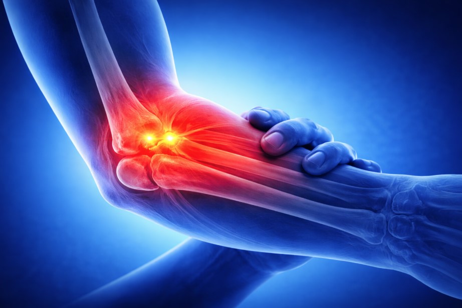 Epicondylitis