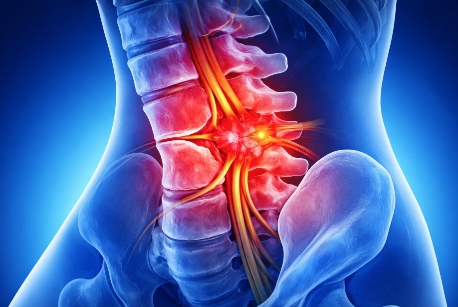 Spinalstenose