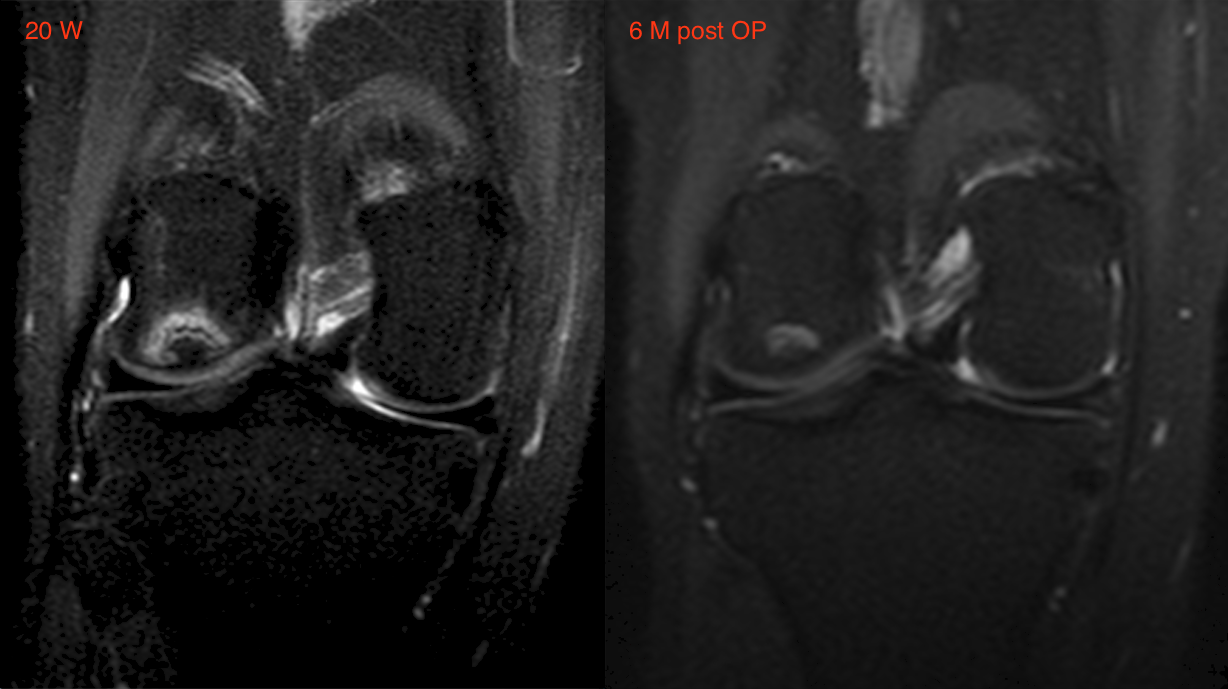 Knee MRI before and after MIBRAR® therapy