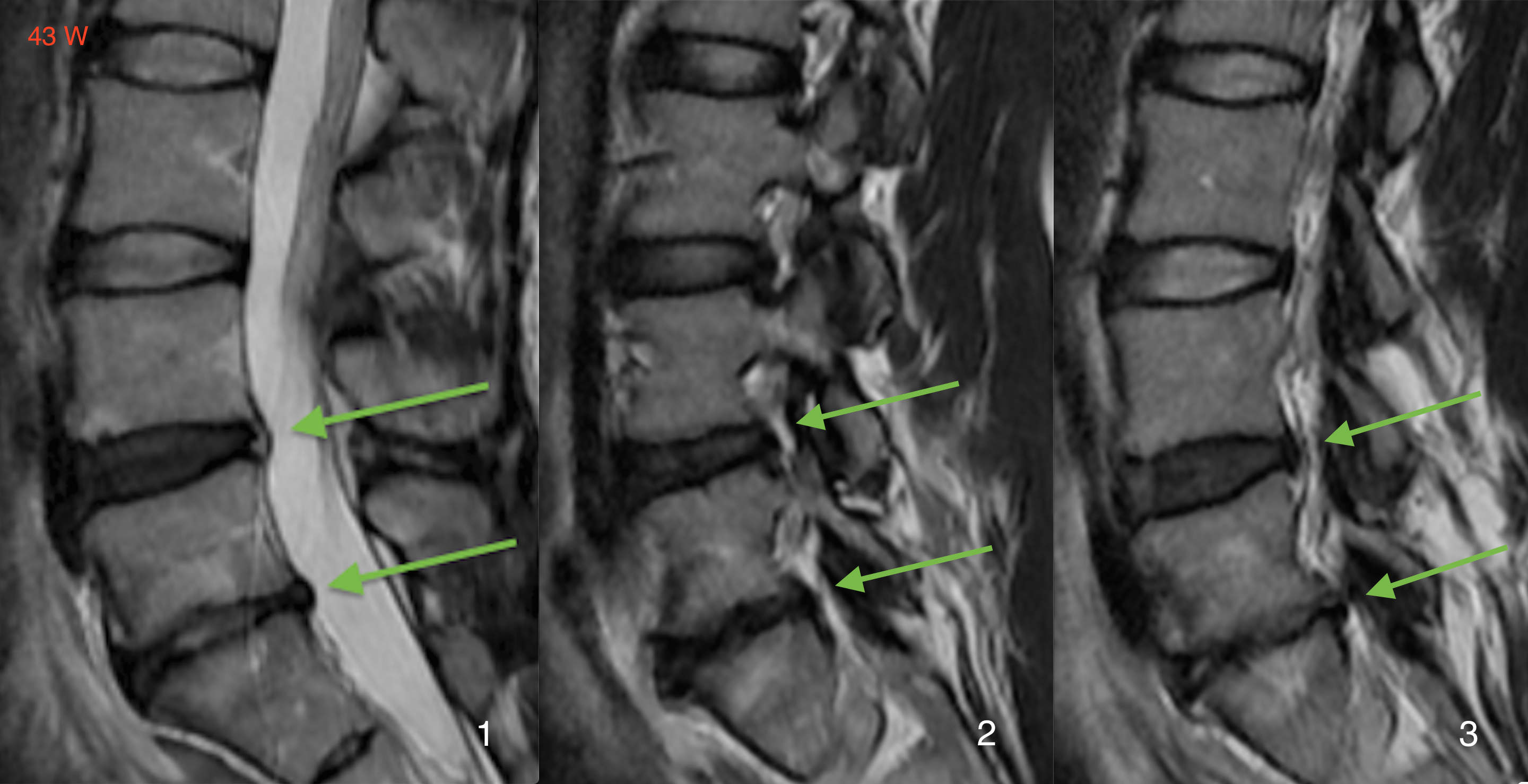 腰椎MRI：脊椎滑脱MIBRAR®前后