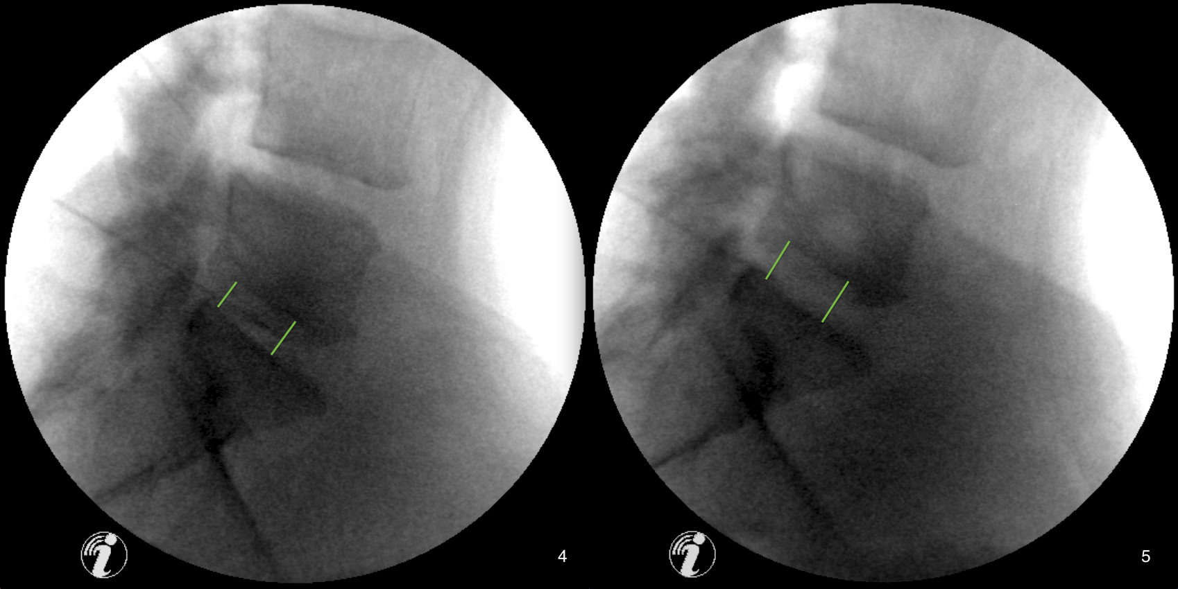 Radiografía columna lumbar — recuperación tras cirugía fallida