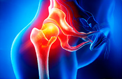 Coxarthrose