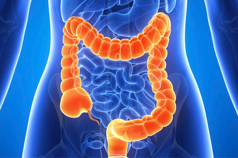 ¿Se puede curar el cáncer de intestino?