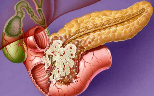 ¿El cáncer de páncreas tiene cura?